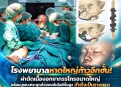โรงพยาบาลหาดใหญ่ก้าวอีกขั้น! ผ่าตัดเนื้องอกขากรรไกรขนาดใหญ่ พร้อมบูรณะกระดูกด้วยเทคโนโลยีขั้นสูง สำเร็จเป็นรายแรกของโรงพยาบาล